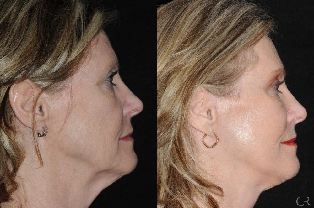 facelift-necklift-9.jpg