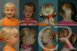 pediatric-otoplasty-1.jpg