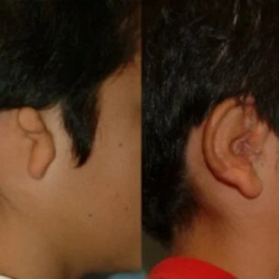ear-reconstruction-9.jpg