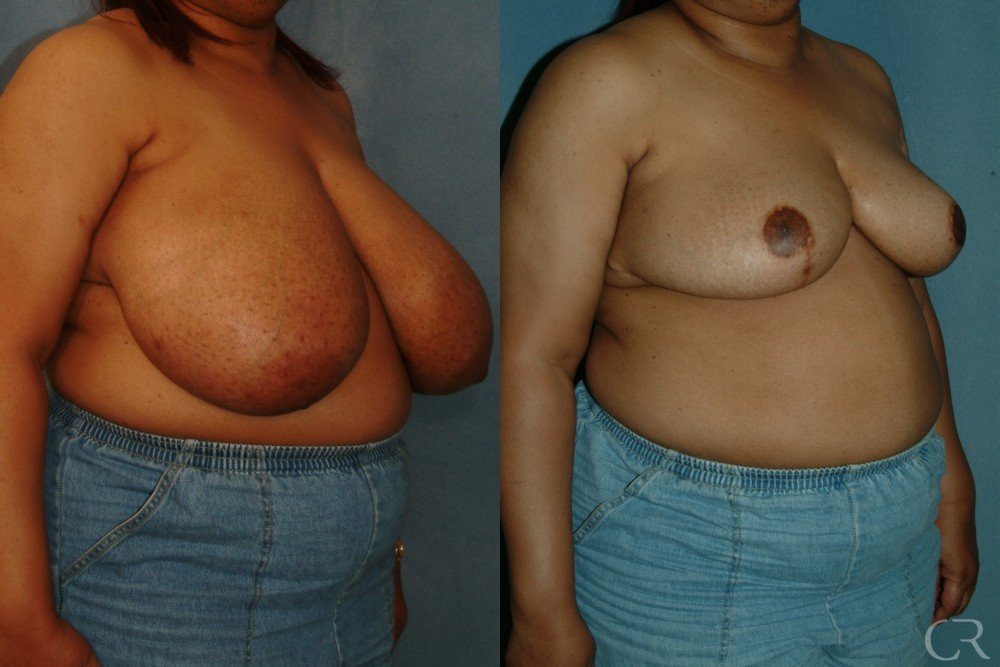 breast-reduction-14.jpg