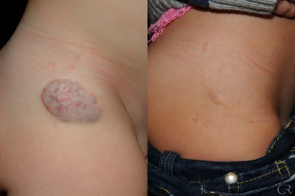hemangioma-30.jpg