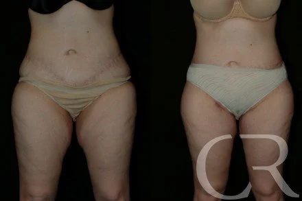 thigh-lift-6.jpg