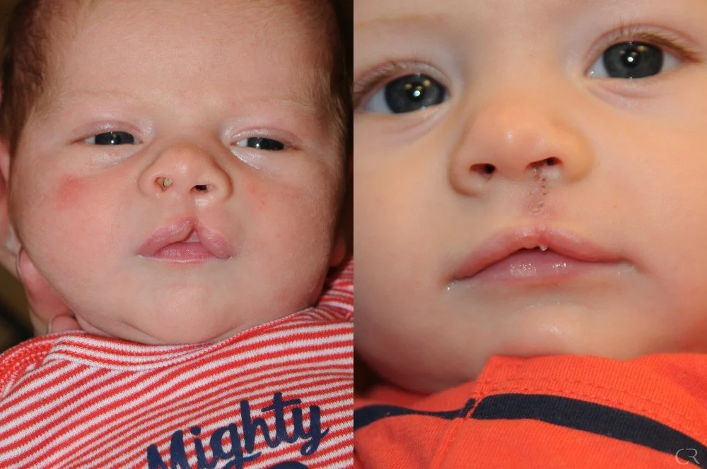 cleft-lip-7.jpg