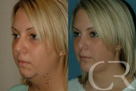 chin-augmentation-1.jpg
