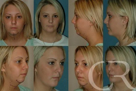 chin-augmentation-4.jpg