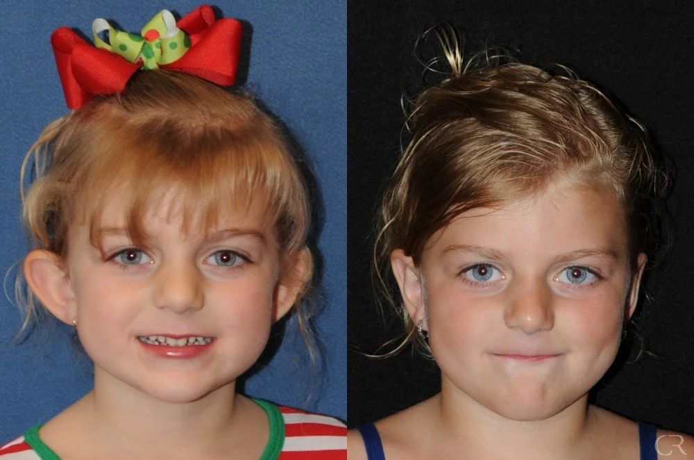 pediatric-otoplasty-18.jpg