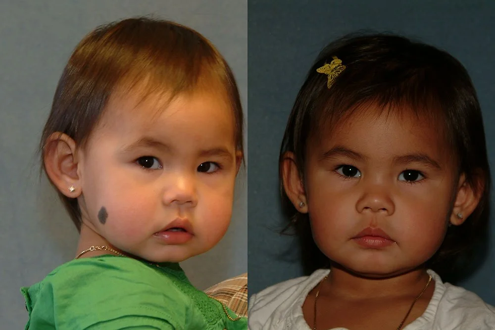 congenital nevus (5).jpg