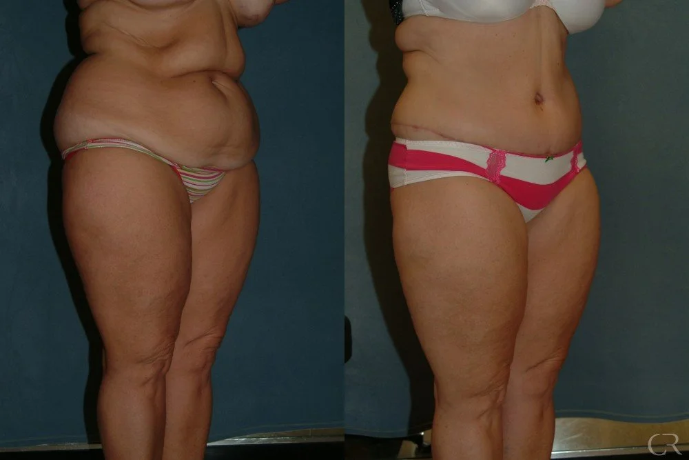 abdominoplasty-2.jpg