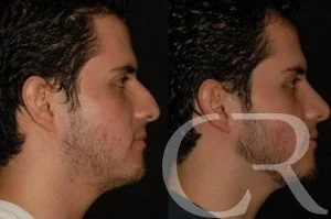 rhinoplasty-13.jpg