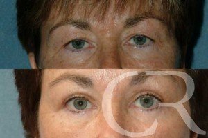 blepharoplasty-18.jpg