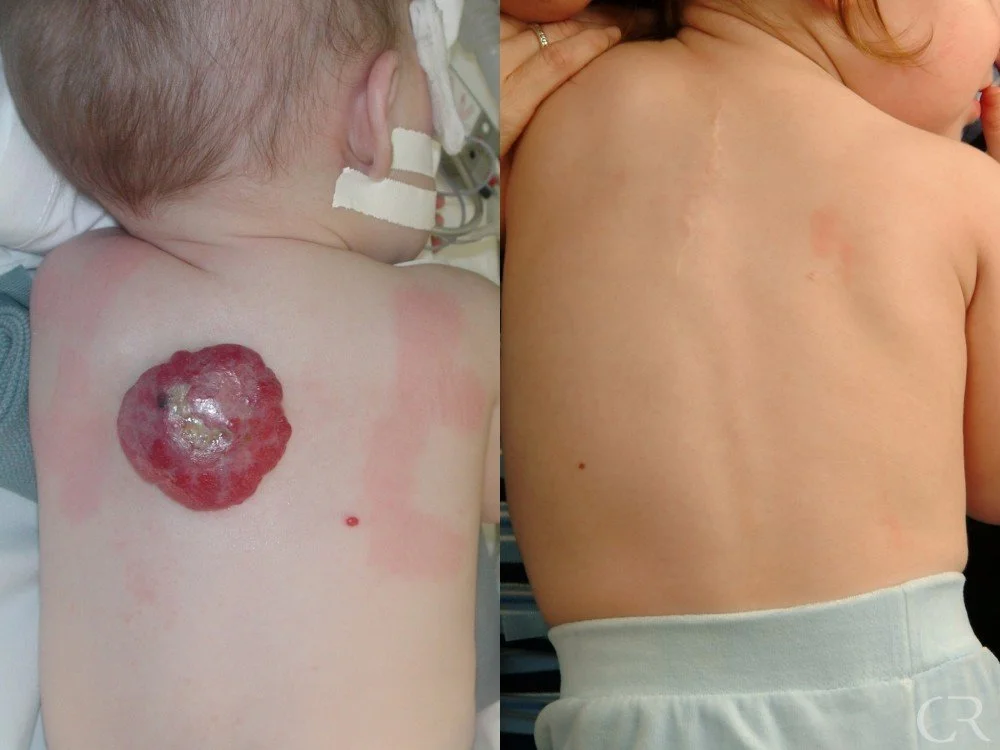 hemangioma-28.jpg