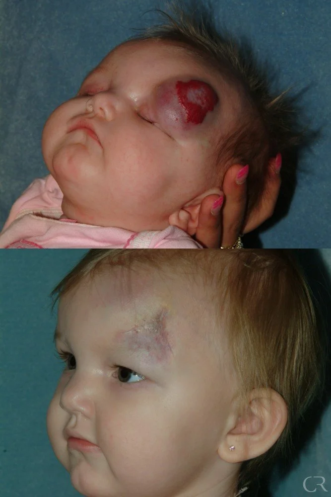 hemangioma-31.jpg