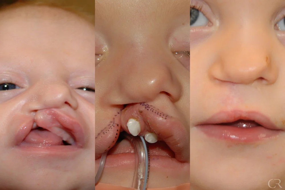 cleft-lip-19.jpg