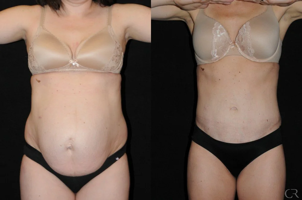 abdominoplasty-12.jpg