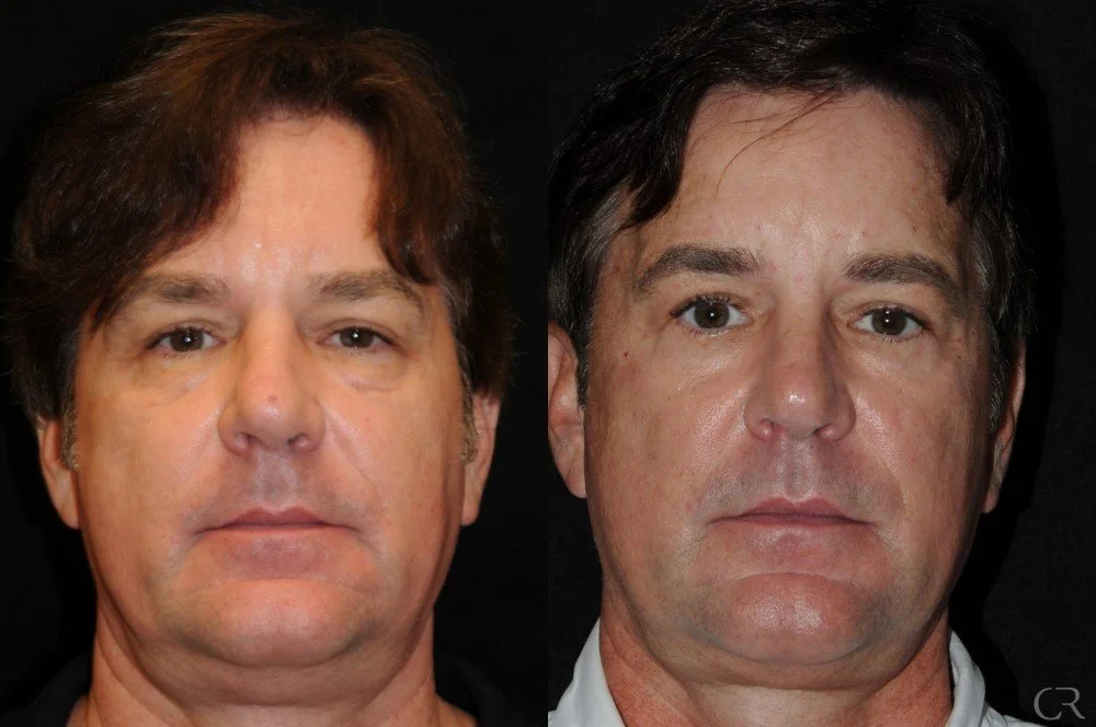 blepharoplasty-4.jpg