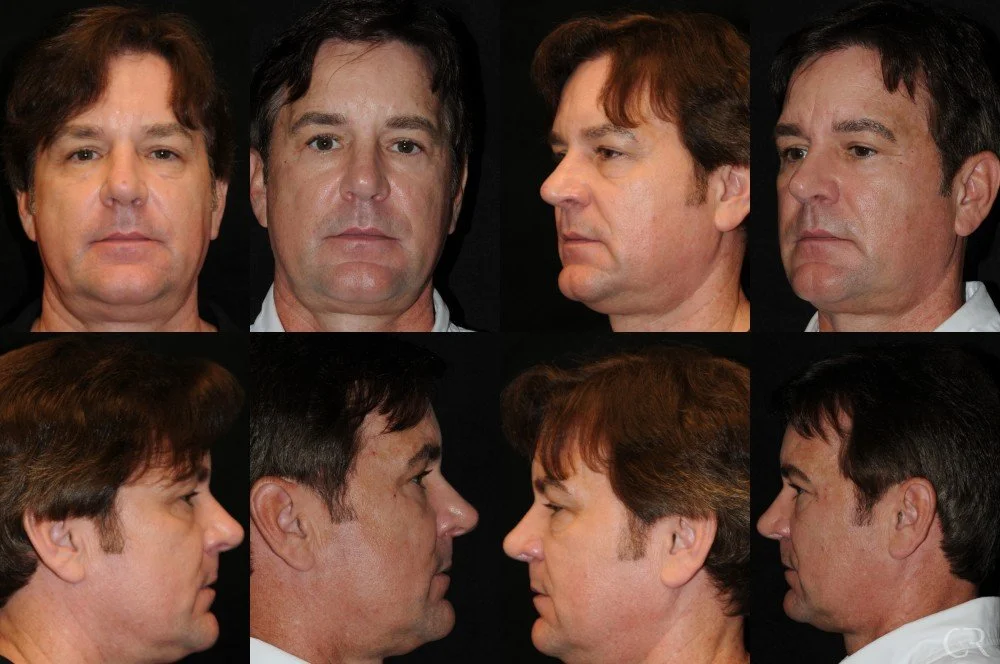 blepharoplasty-1.jpg