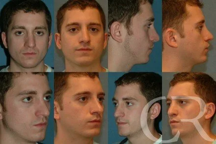 rhinoplasty-4.jpg