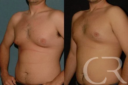 chest-gynecomastia-18.jpg