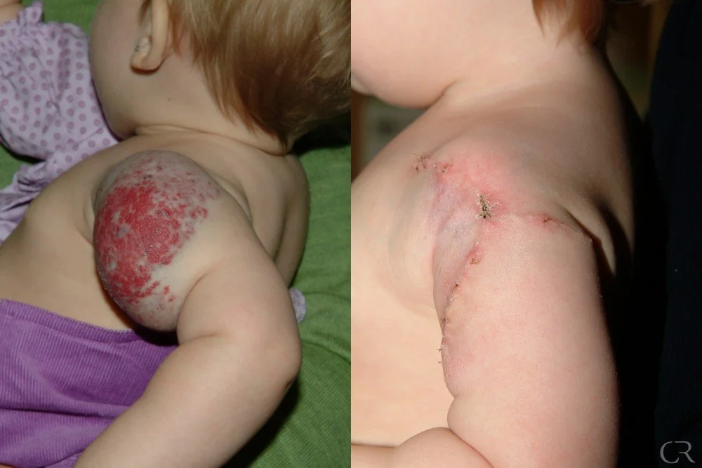 hemangioma-25.jpg