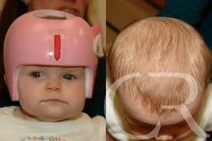 plagiocephaly-1.jpg