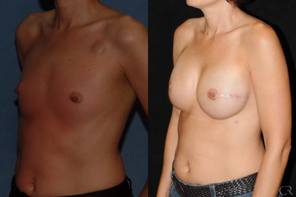 breast-reconstruction-5.jpg