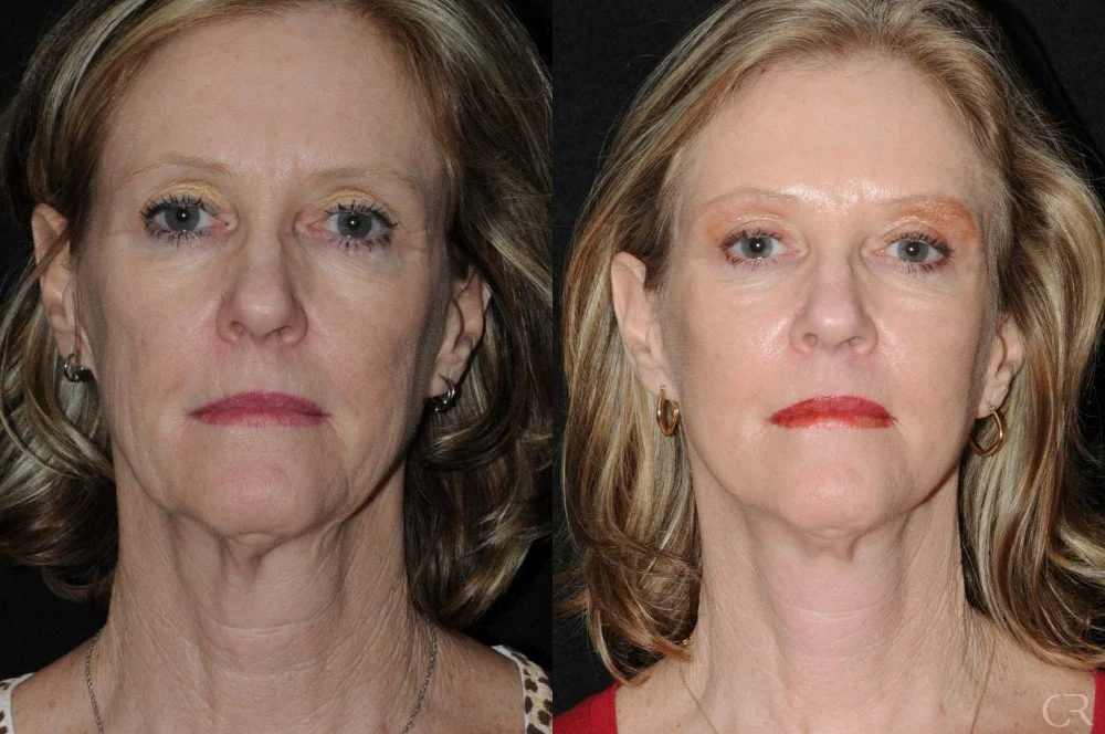 facelift-necklift-6.jpg