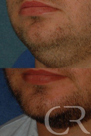 chin-augmentation-2.jpg