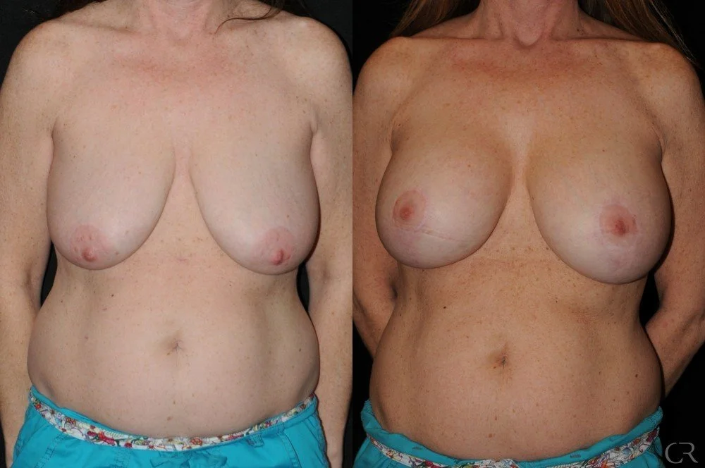 breast-lift-10.jpg