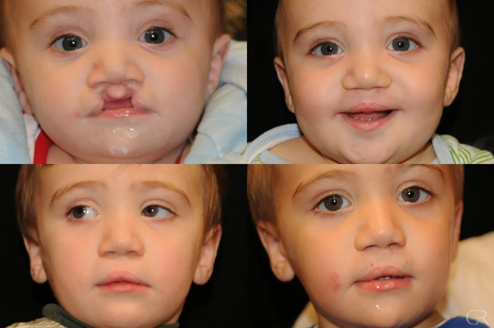 cleft-lip-13.jpg