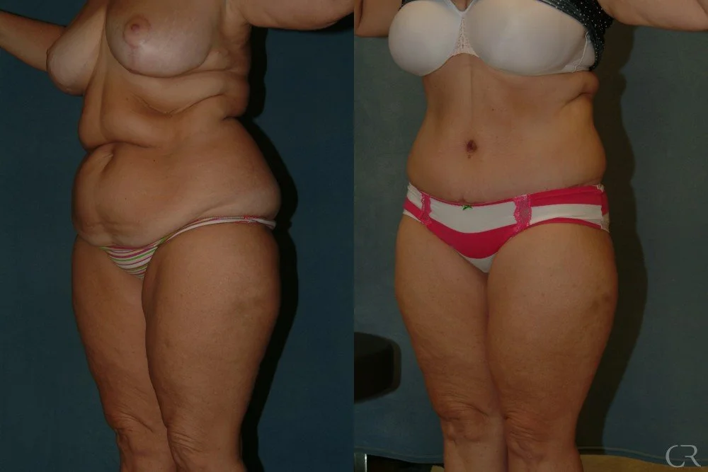 abdominoplasty-5.jpg