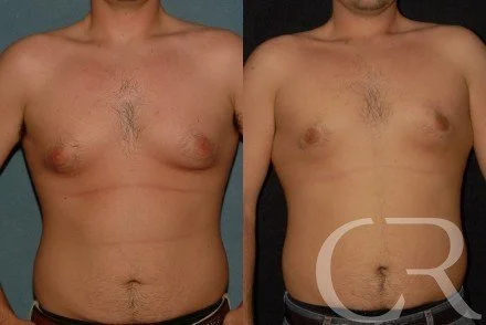 chest-gynecomastia-15.jpg