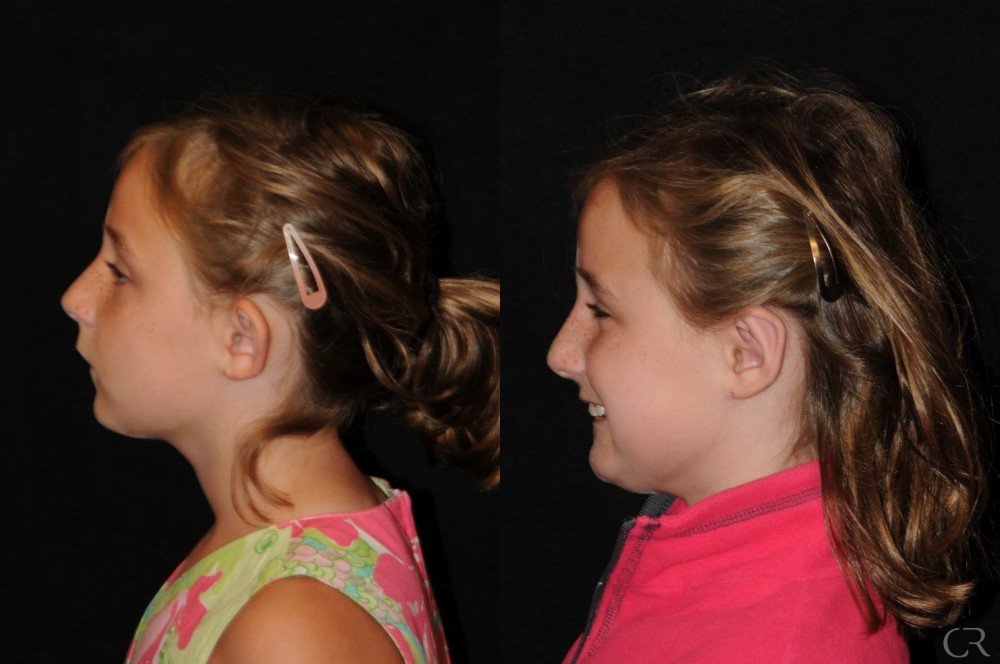 pediatric-otoplasty-8.jpg