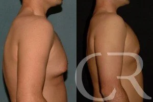 chest-gynecomastia-17.jpg