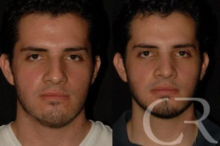 rhinoplasty-10.jpg