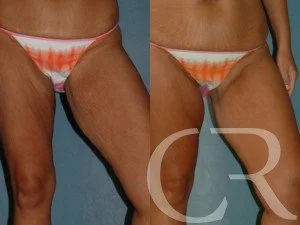 thigh-lift-2.jpg