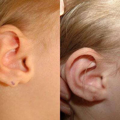 ear-reconstruction-10.jpg
