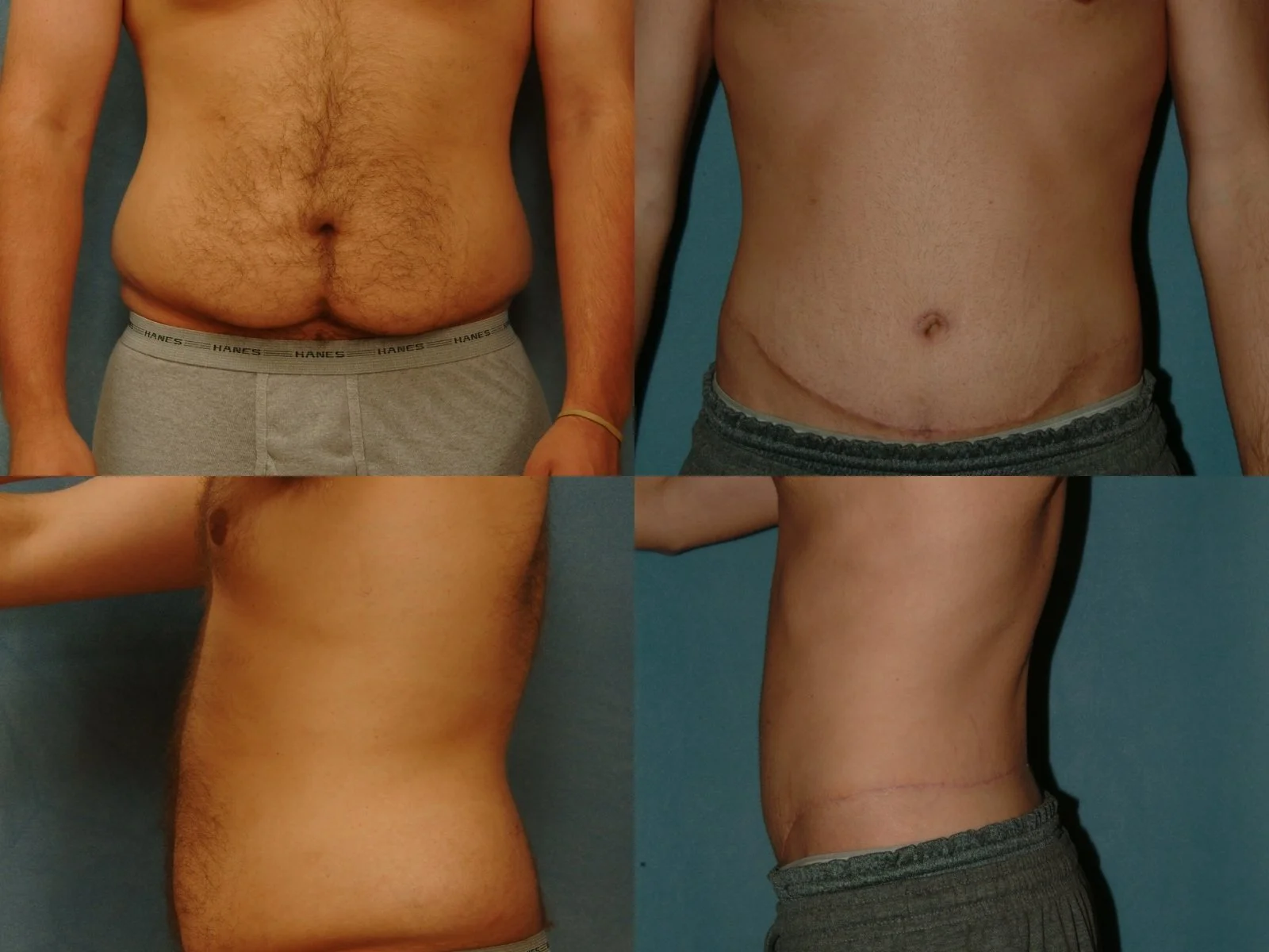 bodylift abdominoplasty.jpg