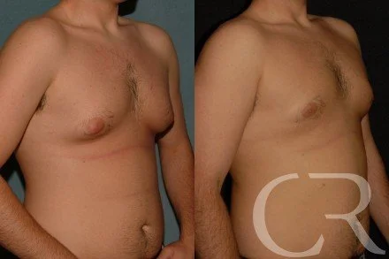 chest-gynecomastia-16.jpg