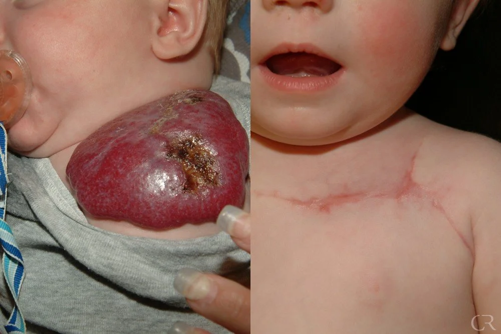 hemangioma-1.jpg