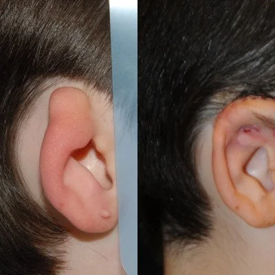 ear-reconstruction-3.jpg