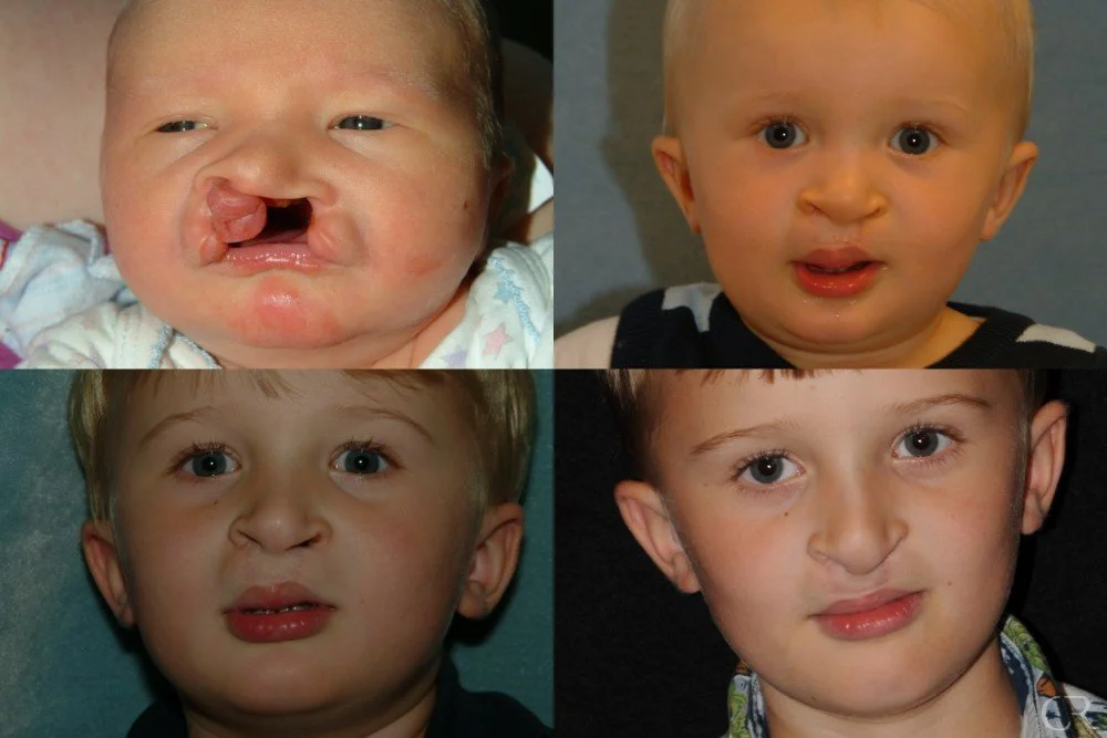 cleft-lip-21.jpg