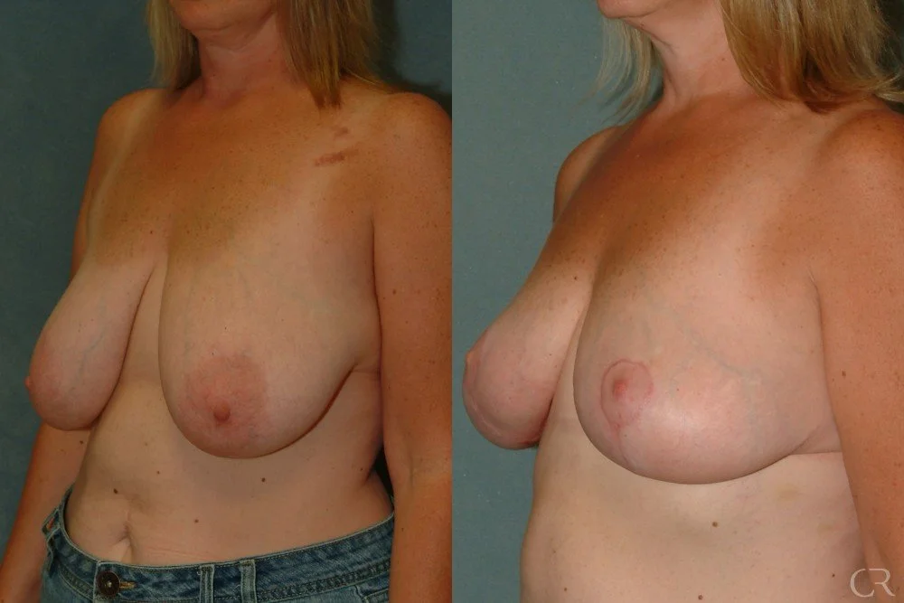 mastopexy-4.jpg