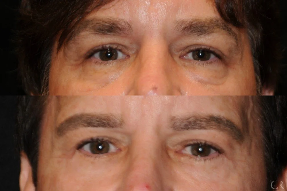 blepharoplasty-2.jpg