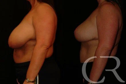 breast-reduction-6.jpg