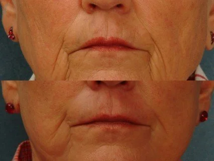 skin-resurfacing-laser-4.jpg