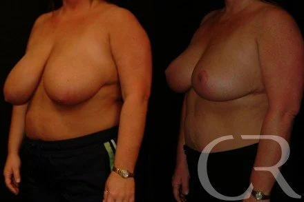 breast-reduction-9.jpg