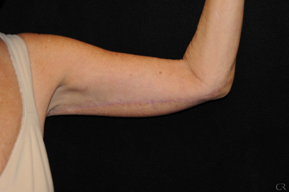 brachioplasty-9.jpg