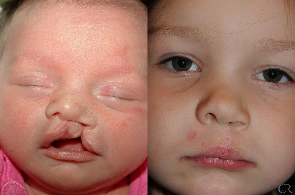 cleft-lip-10.jpg