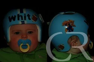 plagiocephaly-9.jpg