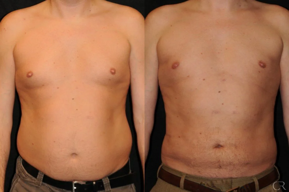 liposuction-3.jpg